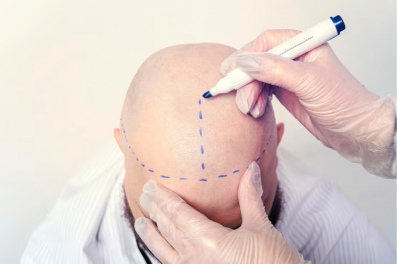 Cirurgia Implante Capilar: Tudo o que Você Precisa Saber Cirurgia Implante Capilar: Tudo o que Você Precisa Saber