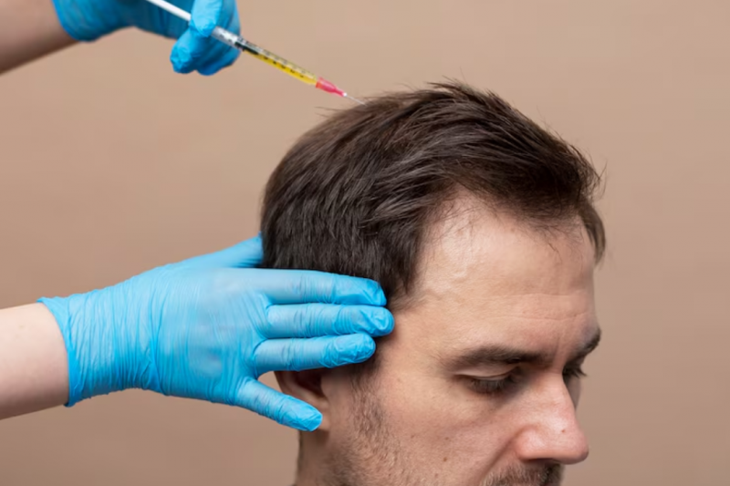 Cirurgia Transplante Capilar: Tudo o que Você Precisa Saber