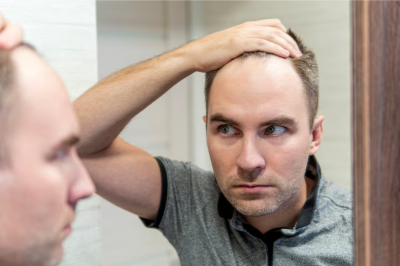 Tratamento para Calvície Masculina: Descubra as Melhores Alternativas Tratamento para Calvície Masculina: Descubra as Melhores Alternativas