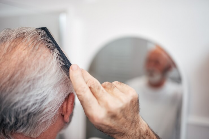 Transplante Capilar FUE é a Solução Ideal para Calvície e Falta de Cabelo Transplante Capilar FUE é a Solução Ideal para Calvície e Falta de Cabelo