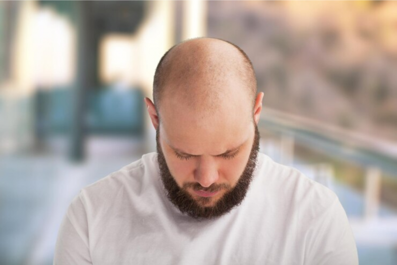Transplante Capilar Masculino Traz Resultados Incríveis para a Calvície Transplante Capilar Masculino Traz Resultados Incríveis para a Calvície