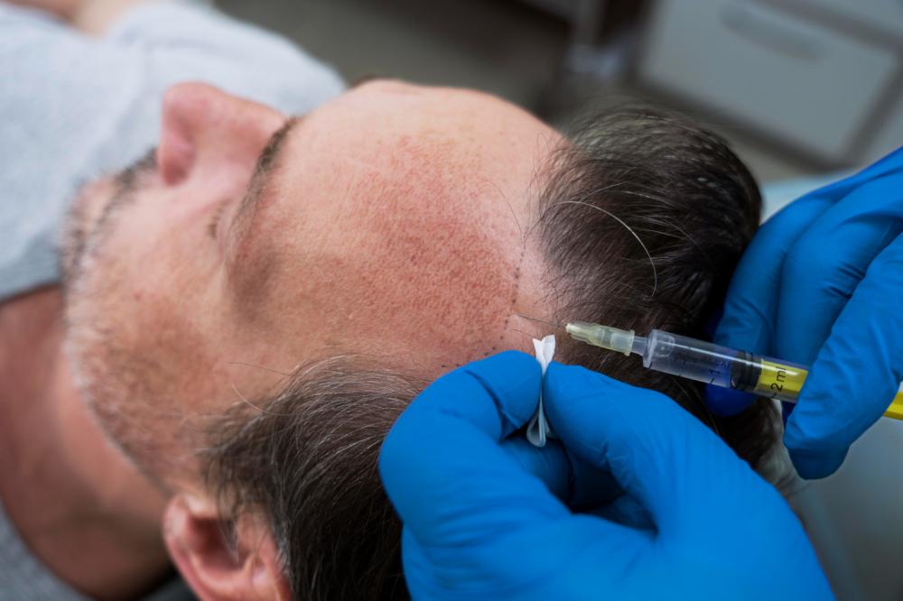 Mesoterapia