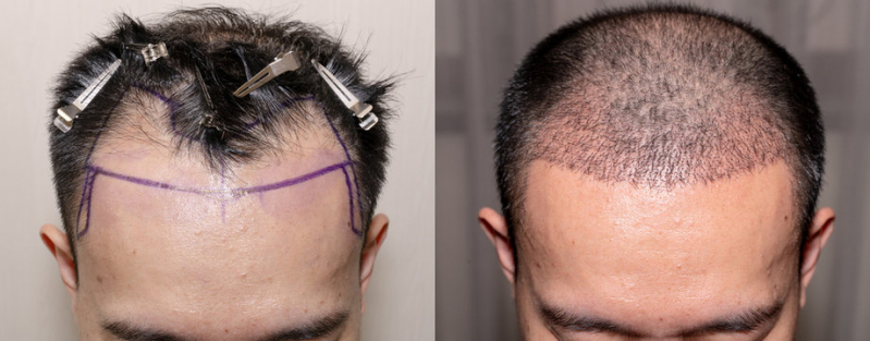 Clínica Que Faz Implante Capilar Cabelo Liso Ponta Porã - Implante de Cabelo Natural