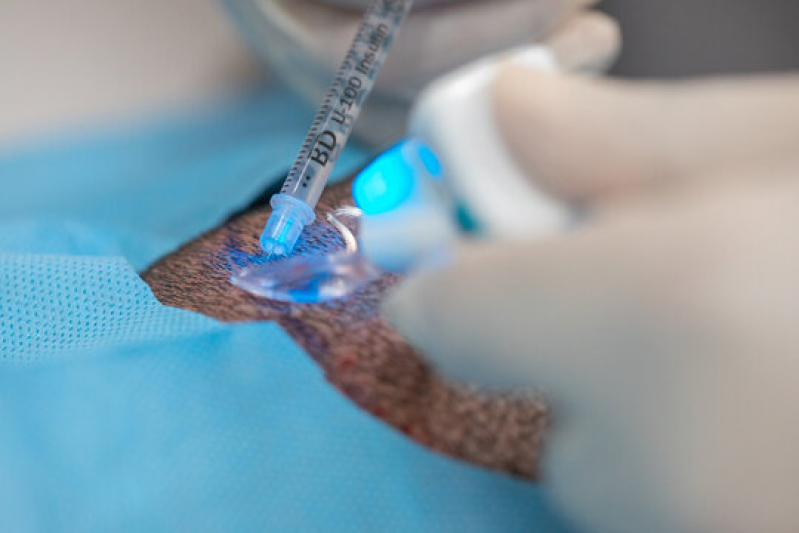 Implante Capilar Definitivo Aparecida de Goiânia - Implante de Cabelo Natural
