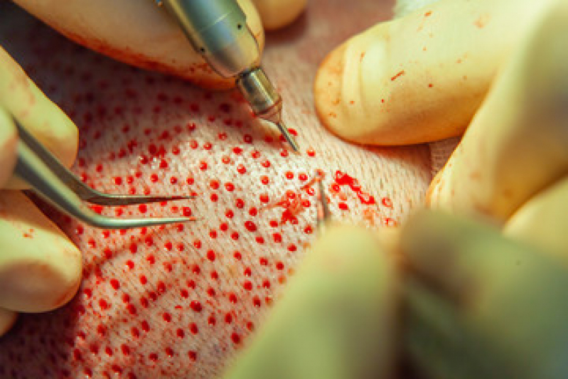 Implante Capilar para Diminuir o Tamanho da Coroa Procedimento Vila Rica - Implante Capilar para Coroa Grande