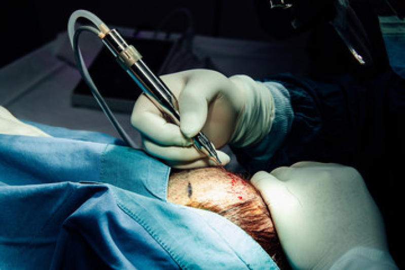 Procedimento de Implante Capilar para Diminuir o Tamanho da Coroa Terenos - Implante Capilar para Coroa Grande