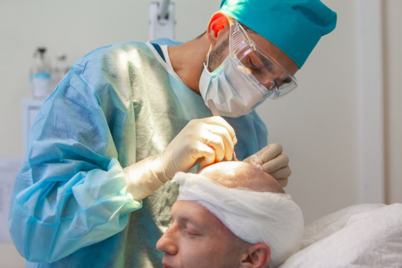 Procedimento de Implante Capilar para Redução de Coroa Poconé - Procedimento para Implante de Cabelos