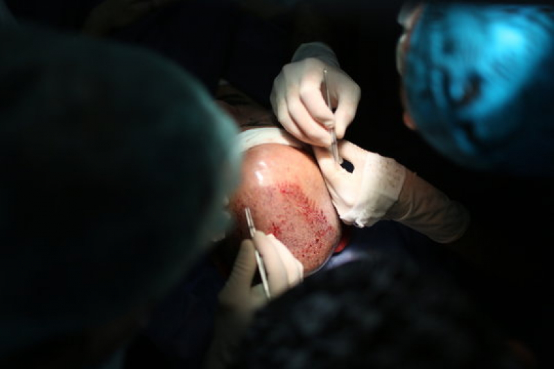 Procedimento de Implante de Cabelo para Diminuir a Coroa Setor de Mansões Dom Bosco - Implante Capilar para Coroa Grande