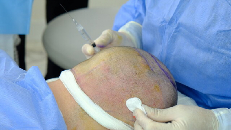 Procedimento de Transplante Capilar na Coroa Tapurah - Implante Capilar para Coroa Grande