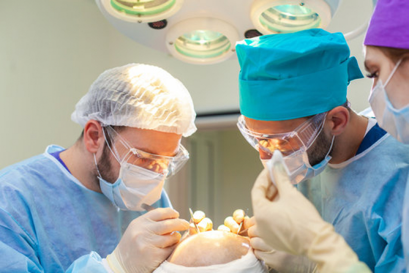 Procedimento Implante Capilar Agendar Naviraí - Procedimento para Implante de Cabelos
