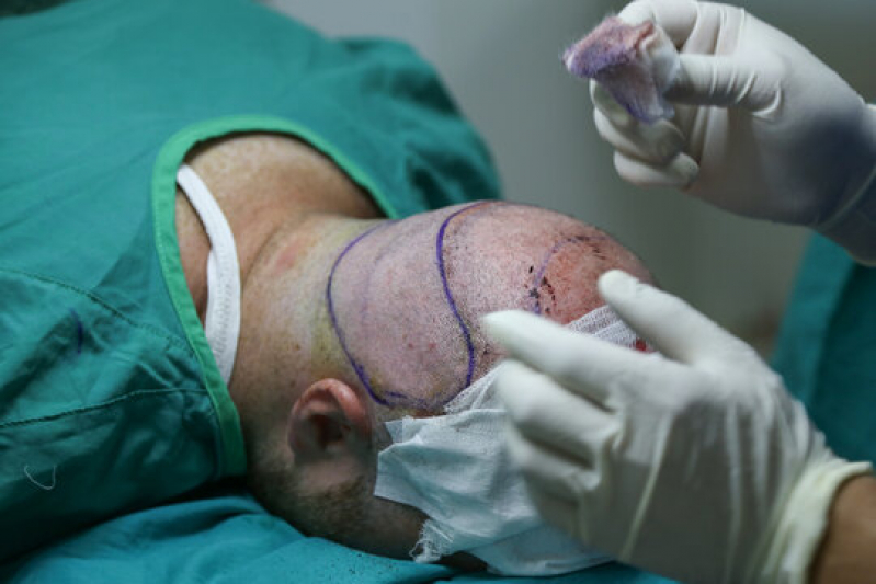 Procedimento para Implante de Cabelos Asa Norte - Procedimento para Implante de Cabelos