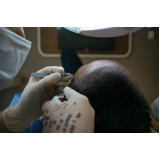 cirurgia de cabelo masculino marcar São Félix do Araguaia