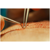 cirurgia de implante cabelo masculino agendar Nova Andradina