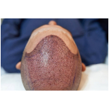 cirurgia de implante cabelo masculino marcar Porto Esperidião