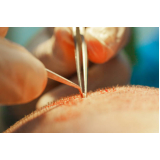 cirurgia de implante capilar na coroa Nobres