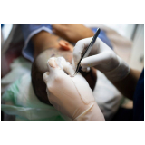 cirurgia de implante de cabelo para homens Setor Mansões do Lago Norte
