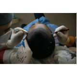 cirurgia de implante de cabelos agendar Maracaju