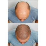 cirurgia de transplante de cabelo masculino marcar Mineiros