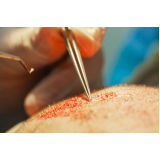 cirurgia para implante de cabelo Setor Mansões do Lago Norte