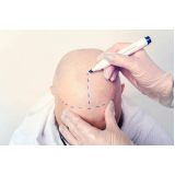 clínica especializada em implantação cabelo Matupá