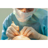 clínica especializada em implante capilar para coroa grande Luziânia