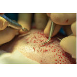 clínica especializada em implante capilar redução de coroa Barra do Garças
