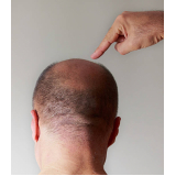 clínica especializada em implante de cabelo feminino na testa Ponta Porã