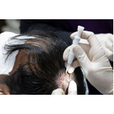 clínica especializada em implante de cabelo para diminuir a coroa Nova Andradina