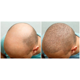 clínica especializada em implante de cabelo para homem Itaberaí