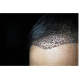 clínica especializada em implante de cabelos Formosa
