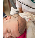 clínica especializada em transplante cabelo Coxim