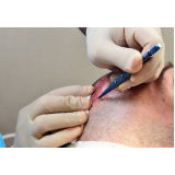 clínica para fazer cirurgia calvície masculina Anápolis