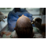 clínica para fazer cirurgia contra calvície masculina Setor de Mansões Dom Bosco