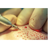 clínica que faz cirurgia de implante capilar na coroa Nova Andradina