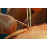 clínica que faz cirurgia de implante capilar para redução de coroa Paranaíta
