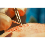 clínica que faz cirurgia para implante de cabelos Nova Bandeirantes