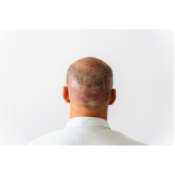 clínica que faz implante cabelo masculino Paranaíta