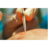 clínica que faz implante calvície Vila Rica