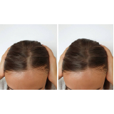 clínica que faz implante de cabelo para mulher Aguas Claras
