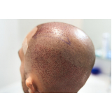 clínica que faz implante de cabelo para mulheres Anápolis