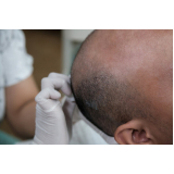 clínica que faz implante de cabelos Alto Taquari