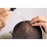 clínica que faz microinfusão de medicamentos no couro cabeludo Trindade