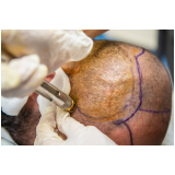 clínica que faz procedimento de implante de cabelo Nova Olímpia