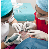 clínicas transplante capilar Vila Rica