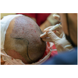 implante capilar permanente procedimento Vila Rica