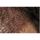 implante de cabelo entradas marcar Marcelândia