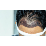 implante de cabelo entradas Confresa