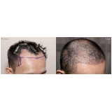 implante de cabelo fio a fio procedimento Itaberaí
