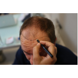 implante de cabelo homem procedimento Campo Novo do Parecis