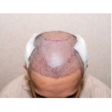 implante de cabelo para diminuir a coroa procedimento Nova Bandeirantes